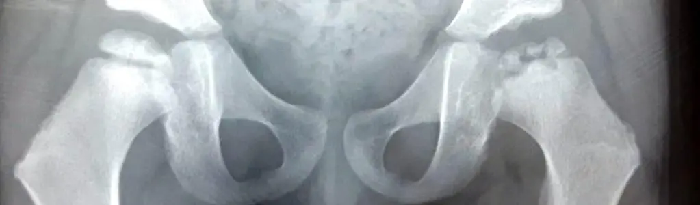 La enfermedad rara de Perthes es una necrosis avascular en la cabeza del f&eacute;mur causada por la falta de riego sangu&iacute;neo.