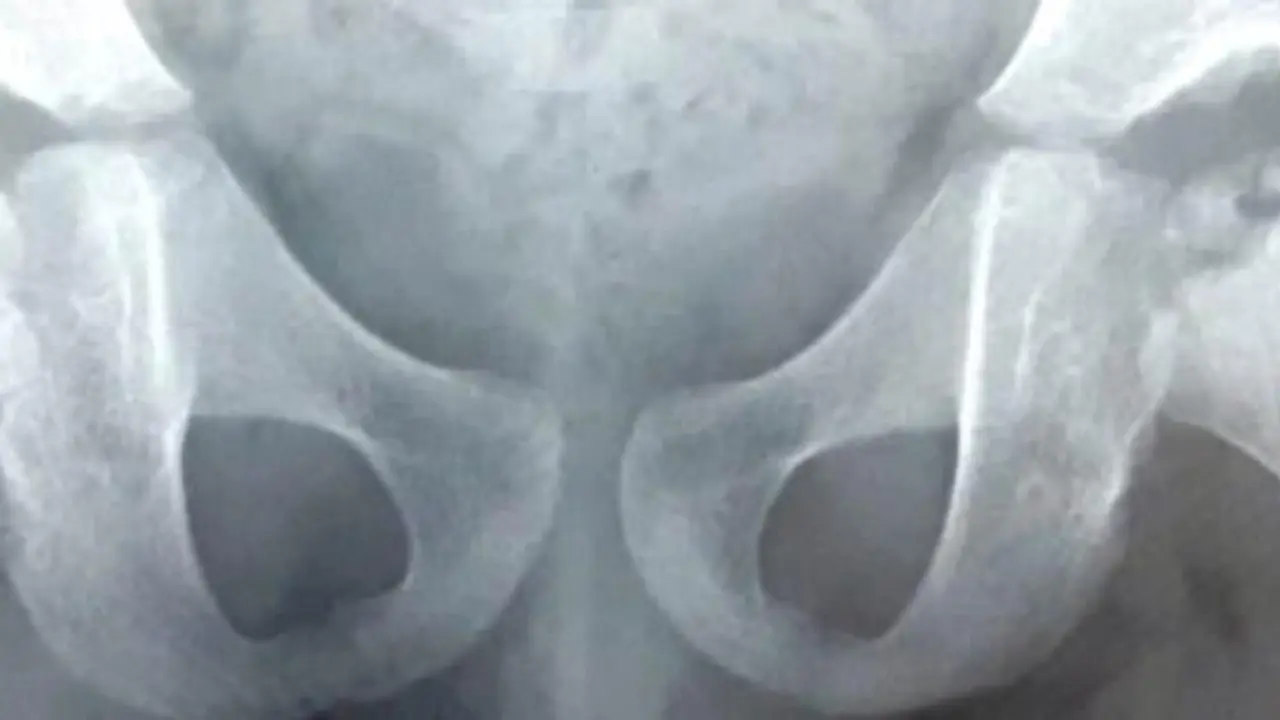 La enfermedad rara de Perthes es una necrosis avascular en la cabeza del f&eacute;mur causada por la falta de riego sangu&iacute;neo.